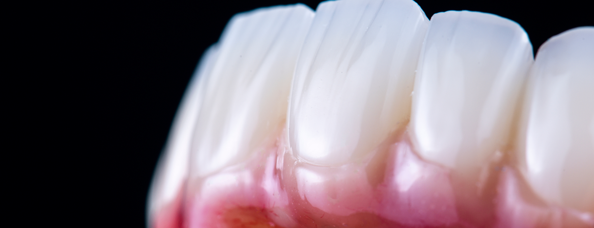 Zirconia dental crown with digital scan overlay