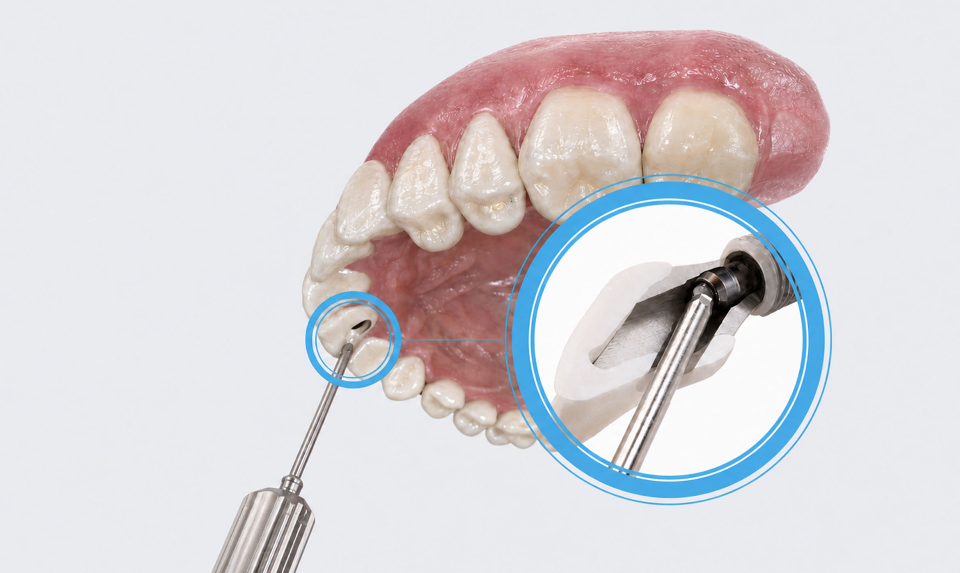 Angulated screw channel abutment detail